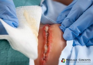 moulage odorous wound