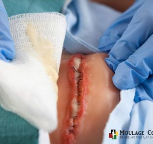 moulage odorous wound