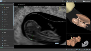 3D Systems U/S Mentor Ultrasound OB-GYN Simulator Also Offers Fetus Scanning Module