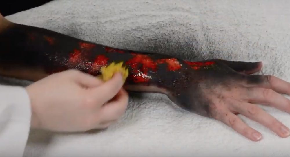 Moulage Burns How to